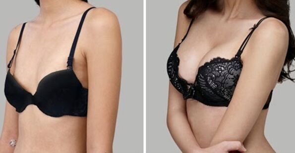 antes e depois da mamoplastia de aumento