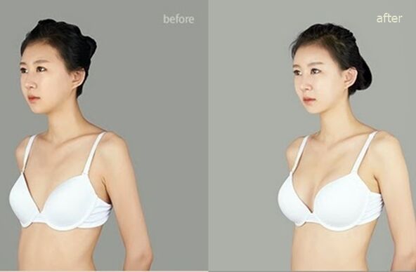 antes e depois de mamoplastia de aumento plástica