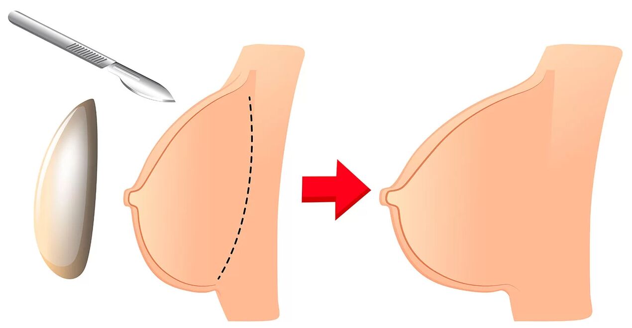 Aumento de mama com implante