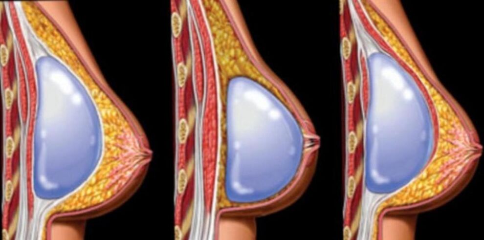 Instalação de implantes