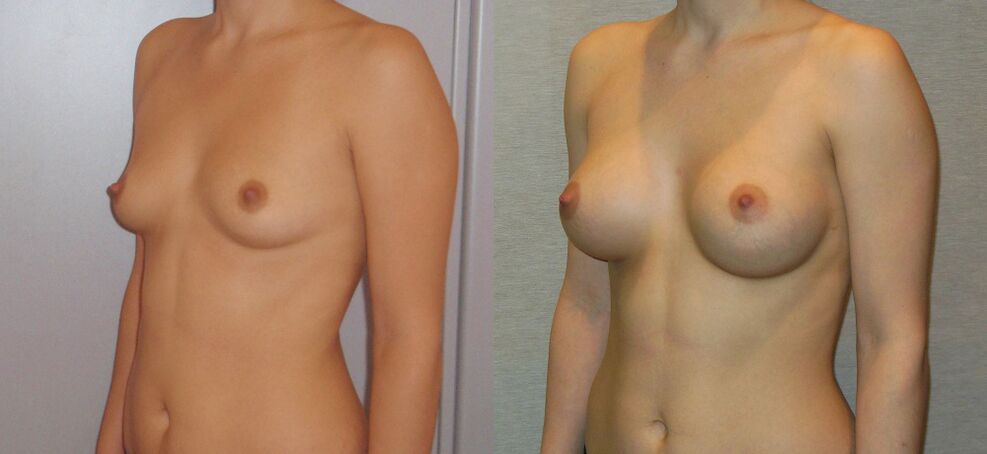 Ampliação do peito antes e depois