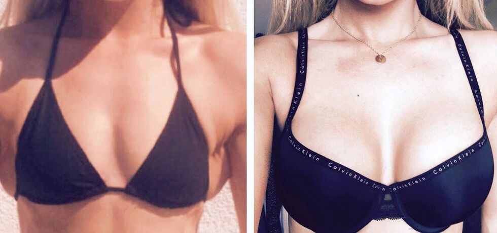 Antes e depois do aumento do peito
